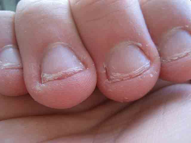 Onychophagia