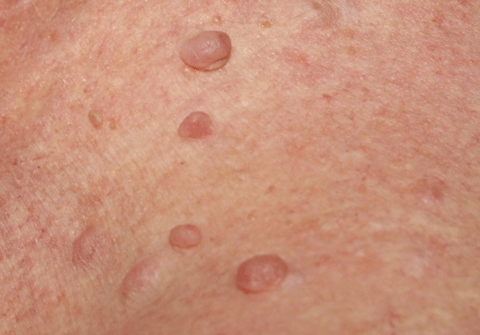 Скрофулодерма (scrophuloderma)
